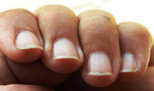Dr. Nauman Niaz's Mahmooda Niaz Clinic - NAIL SIGNS-02 Ice pick-like  #depressions in the #nails (nail #pitting) are common in people who have  psoriasis — a condition #characterized by scaly patches on