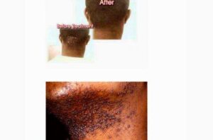 Inkey Razor Bump The Razor Bump and its solution - Jamaica Observer