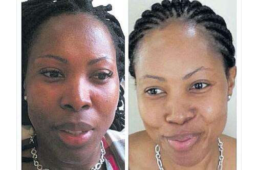 glutathione injection before and after black skin Bleaching What is Glutathione? - Jamaica