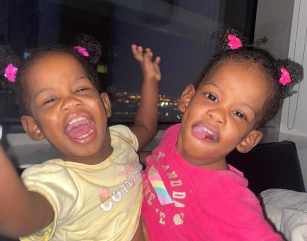 Gêmeas siamesas separadas com sucesso na Arábia Saudita: Uma história de esperança que vai te emocionar!