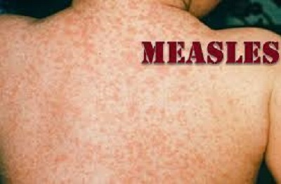 PAHO calls to strengthen vaccination amid rising measles cases